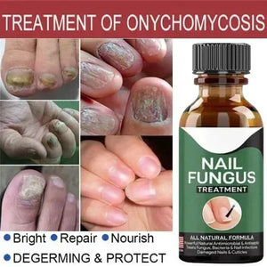Nail Repair Serum – Fast Fungus Treatment (Natural Formula)