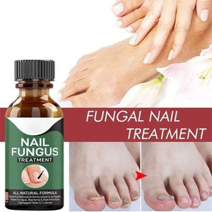 Nail Repair Serum – Fast Fungus Treatment (Natural Formula)